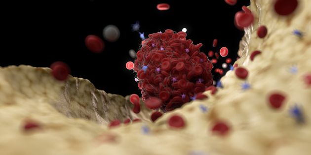 Το παράδοξο με τις θρομβώσεις που προκαλεί το εμβόλιο της AstraZeneca και πώς